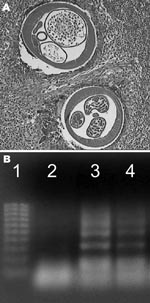 Thumbnail of A) Histologic analysis of skin nodules caused by human subcutaneous dirofilariasis. Cross-sections of Dirofilaria repens surrounded by an inflammatory granuloma. Note the uteri with developing embryos (hematoxylin and eosin stain, original magnification 10×). B) Analysis of patient samples by agarose gel electrophoresis. Lane 1, 100-bp DNA molecular mass weight marker; lane 2, negative control; lane 3, positive control; lane 4, patient sample showing banding pattern typical of the p