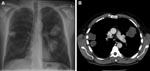 Thumbnail of A) Chest radiograph and B) computed tomography scan of the patient showing 3 nodular Cryptococcus gattii infiltrates near pleura.