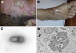 Thumbnail of Nosocomial buffalopoxvirus infection of patients in burns units. A) Lesions involving intact skin around a burn wound and the wound itself. B) Lesions around an insertion site for an intravenous line. C) Orthopoxvirus particles detected by electron microscopy (EM) examination of negatively stained grids prepared from pustular material (magnification ×73,000). D) Transmission EM examination of ultrathin sections of infected Vero cell cultures showing classic intracytoplasmic orthopoxvirus factories and maturing virus particles (magnification ×21,000).