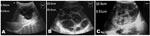 Thumbnail of Ultrasonographic images of cystic echinococcosis in the liver in patients from the Yanahuanca district, Central Peruvian Highlands. A) Cyst type CE1; B) Cyst type CE2; C) Cyst type CE4.