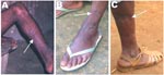 Thumbnail of Wounds resulting from bites or scratches from a nonhuman primate. A) Participant no. 801001. B) Participant no. AG16. C) Participant no. 210301.