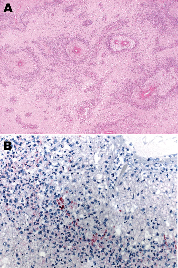 A) Subcortical cerebral white matter with numerous perivascular foci of demyelination and necrosis (hematoxylin and eosin stain, original magnification ×40). B) Immunohistochemical evidence of Mycoplasma pneumoniae antigen inside macrophages present in the perivascular inflammatory infiltrate (immunohistochemical assay performed by using the monoclonal anti–M. pneumoniae antibody and naphthol fast red as counterstain, original magnification ×100).