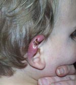 Thumbnail of Ear of an 18-month-old child with culture- and PCR-confirmed Buruli ulcer who briefly visited St. Leonards, Australia, in 2001 (Figure 2). The initial lesion resembled a mosquito bite or that of another insect.