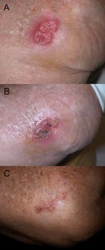 Thumbnail of A) Irregular, erythematous, painful ulcerated plaque of the external side of the left elbow of the patient before treatment. B) Eight weeks after beginning treatment. C) Twenty weeks after beginning treatment.