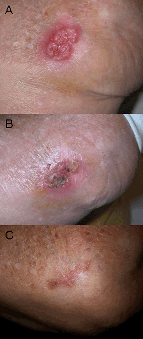 A) Irregular, erythematous, painful ulcerated plaque of the external side of the left elbow of the patient before treatment. B) Eight weeks after beginning treatment. C) Twenty weeks after beginning treatment.