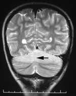 Thumbnail of Coronal T2-weighted magnetic resonance imaging of the brain in a 4-year-old child with Baylisascaris procyonis eosinophilic meningitis. Arrow shows diffuse edema of the superior cerebellar hemispheres. Scale bar increments = cm.