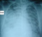Thumbnail of Radiograph showing pneumonia in a patient (case 3) with Rickettsia australis infection.