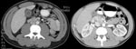 Thumbnail of Computed tomographic scans of abdomens of 2 patients with inflammation of the gallbladder.