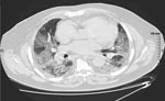 Thumbnail of Thoracic computed tomographic scan on day 3, showing bilateral alveolo-interstitial infiltrates.