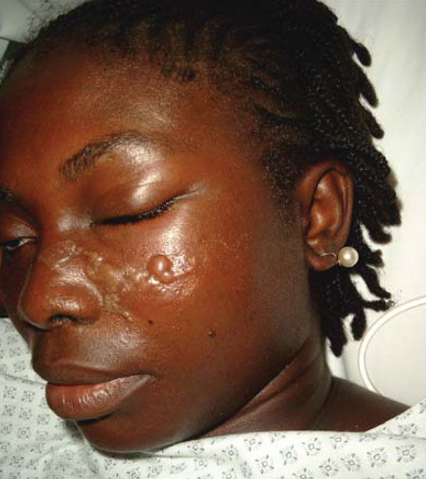 Romaña sign. Photo of female patient from French Guiana who lives in a metropolitan area of France. She had returned to Maripassoula to visit her parents during the holidays between July 13, 2004, and September 3, 2004. When the patient sought treatment on September 3, 2004, she had fever and unilateral periorbital edema.