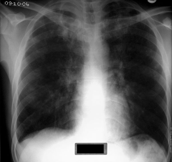 Chest radiograph of a tuberculosis patient addicted to crack cocaine.