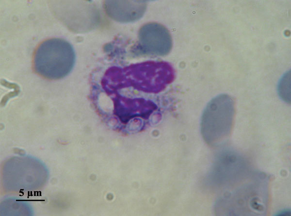 Direct examination of bone marrow smear. Intracytoplasmic Histoplasma capsulatum var. capsulatum.