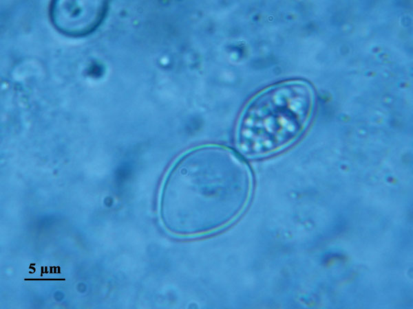 Direct examination of sputum fluid showing Histoplasma capsulatum var. duboisii.