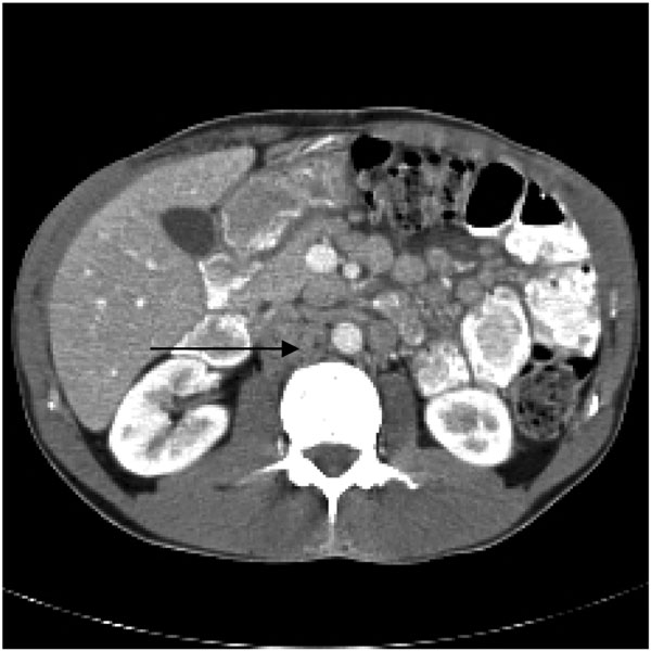 Initial computed tomographic scan of the abdomen, performed after intravenous injection of contrast dye, showing numerous enlarged para-aortic lymph nodes (arrow).