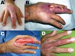 Thumbnail of Patient 8. A) Nonulcerative edematous lesion on the right middle finger as first seen; B) ulcerated lesions on the right middle finger ≈4 weeks later; C) extensive debridement, 5.5 weeks after first seen; D) cured lesion 5 months after first seen, 1 month after autologous skin graft.