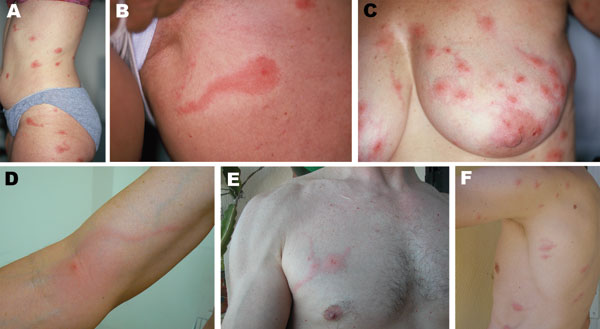 A–F) Photographs of 6 persons with skin lesions of Pyemotes ventricosus dermatitis. Note the central microvesicles, ulcerations or crusts, and some lesions with the comet sign. D) Lymphangitis-like dermatitis. E, F) Lesions resulting from natural infection of 2 of the investigators.