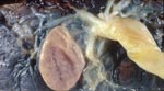 Thumbnail of Fetal side of the placenta from Latin American pregnant woman who delivered her baby at Geneva University Hospitals, Geneva, Switzerland. A macroscopic subchorial liquid-filled cyst can be seen near the umbilical cord insertion.