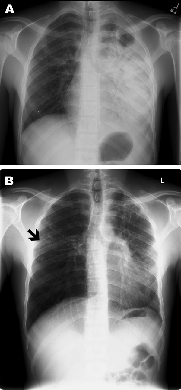 Poster-anterior chest radiographs of patient with multidrug-resistant tuberculosis. A) Radiograph taken at diagnosis, demonstrating dense consolidation of the left lower lobe and lingula. A left apical cavity is present. Minimal change is also noted in the right mid-lung zone. B) Radiograph taken after 5 months of directly observed therapy. Marked clearance is noted on the left; however, a new small cavitary lesion with surrounding infiltrate is noted in the right mid-lung zone (black arrow).