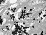 Thumbnail of Grocott methamine silver–stained section from a skin biopsy specimen of a bottlenose dolphin (Tursiops truncatus) showing abundant Lacazia loboi yeast cells individually and in chains connected by thin tubular bridges. Magnification ×400.