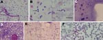 Thumbnail of Microscopic appearance of Babesia sp. EU1 sporozoites isolated from tick salivary glands and of subsequent asexual development in erythrocytes. Sporozoites were stained with Giemsa and observed in the suspension of crushed salivary glands (A, B) and from salivary glands directly crushed between slides (C, D, E). Arrows indicate sporozoite dividing forms. A composite panel of asexual stages cultivated in sheep erythrocytes from these sporozoites is presented (F); developmental stages