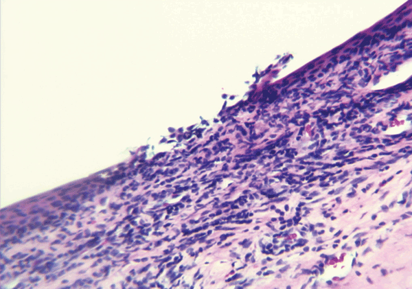 Scleral nodule biopsy sample, showing microulceration of corneal epithelium (magnification ×20, hematoxylin and eosin stain), Araguatins, Brazil. Source: Department of Pathology, University of Brasília.