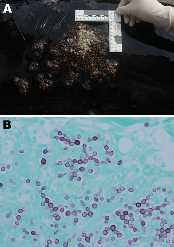 A) Serpiginous dermal nodules covering the dorsum of an offshore bottlenose dolphin (KLC020). B) Gomori methenamine silver–stained sections of dermis showing yeast-like structures connected by neck and arranged at various angles (magnification ×400). Scale bar = 100 μm.