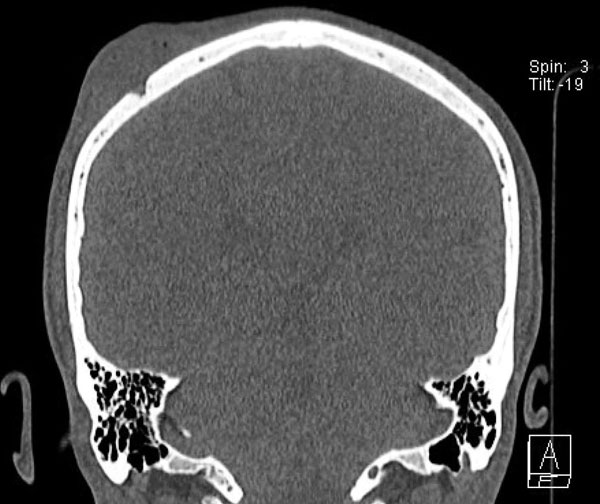 Computed cranial tomography image of the patient showing a swelling at the right parietal area and a small defect of the bone.
