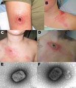 Thumbnail of Cowpox virus infection in 3 persons in northern France caused by transmission from infected pet rats. Cutaneous lesions caused by cowpox virus are shown in patient 1 (A), patient 3 (B) and patient 4 (C, D). The 2 latter patients had lymphangitis associated with the local lesion. Panel C was obtained on January 30, 2009, panel D on February 6, 2009. Negative-staining electron microscopy showed mulberry forms with conspicuous but short, randomly arranged surface tubules (E) and capsul