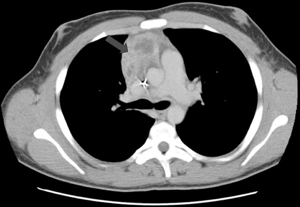 Computed tomographic scan of thorax showing extension of infection with Aspergillus viridinutans into mediastinal structures (arrow).