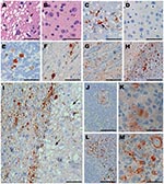 Thumbnail of Immunohistochemical analysis of squirrel monkeys infected with chronic wasting disease (CWD) agent. Panels A, C, and E–M are from squirrel monkeys infected with CWD. Panels B and D are from an uninfected monkey showing no pathologic changes or positive staining for protease-resistant prion protein (PrPres). Panels A and B, cerebral cortex stained with hematoxylin and eosin; panels C and D, thalamus stained with antibody 3F4 against PrP (arrows); panels E and F, cerebellar granular c