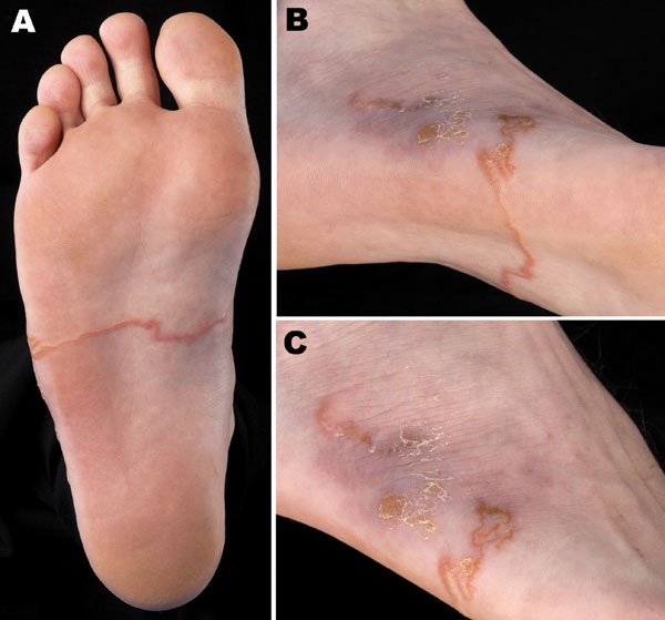 Right foot of a patient from Brittany, France, with a hookworm-related cutaneous larva migrans, showing an elevated serpiginous lesion on the sole of the foot (panels A, B) and ulcerative lesions at the origin of the lesions on the lateral side of the foot (panel C).