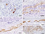 Thumbnail of Avian bornavirus protein demonstrated by immunohistochemical testing in extracerebral locations. A) within neurons of proventricular intramural vegetative ganglia with inflammatory infiltration, bar = 25 µm; B) within nerve fibers of the myenteric plexus of gizzard, bar = 25 µm; C) within smooth muscle fibers of the proventricular wall, bar = 50 µm; D) within a modified muscle fiber of the conductive system of the heart, bar = 50 µm; E) within myocardiocytes, bar = 25 µm.