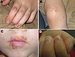 Thumbnail of Vesicular eruptions in A) hand, B) foot, and C) mouth of a 6.5-year-old boy from Turku, Finland, with coxsackievirus (CV) A6 infection. Several of his fingernails shed 2 months after the pictures were taken. D) Onychomadesis in a 10-year-old boy from Seinäjoki, Finland, 2 months after hand, foot and mouth disease with CVA6 infection. Photographs courtesy of H. Kujari (A–C) and M. Linna (D).