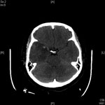 Thumbnail of Computed tomography scan showing hemorrhage in edematous part of brain of patient with herpes simplex virus encephalitis, day 5 of hospitalization.
