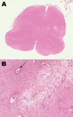 Thumbnail of A) Horizontal section of the medulla at the level of the inferior olivari nuclei, showing multiple inflammatory areas (clear areas); original magnification ×4. B) Severe edematous area with inflammatory cells, macrophages, edema, and perivascular cuffing (arrow); original magnification x200, hematoxylin-eosin stain.