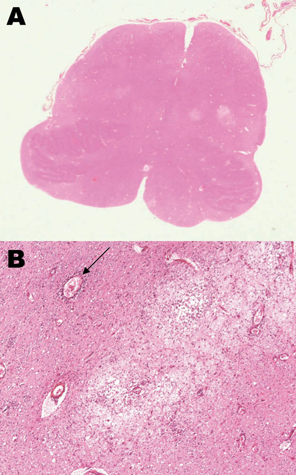 A) Horizontal section of the medulla at the level of the inferior olivari nuclei, showing multiple inflammatory areas (clear areas); original magnification ×4. B) Severe edematous area with inflammatory cells, macrophages, edema, and perivascular cuffing (arrow); original magnification x200, hematoxylin-eosin stain.