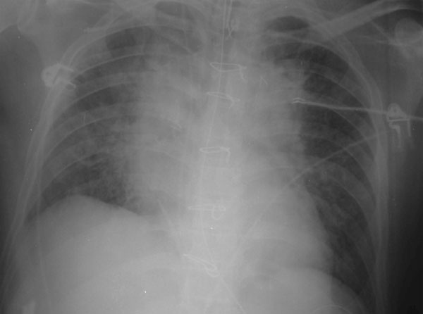 Chest radiograph of patient no. 5, who had community-acquired pneumonia associated with Tropheryma whipplei.