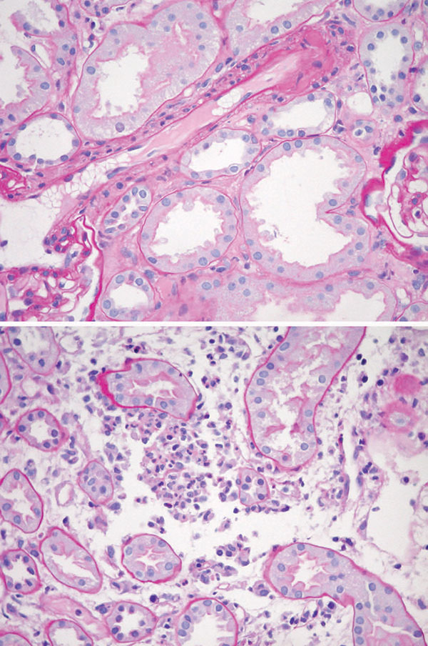 Acute tubular necrosis in a renal biopsy specimen of the patient. Magnification ×40.