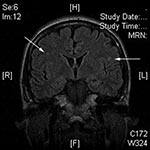 Thumbnail of Magnetic resonance imaging of the brain of patient B, showing several nonspecific areas of enhancement (arrows), which suggests encephalitis, given the clinical scenario.