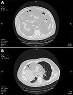 Thumbnail of Computed tomography scans of the patient, showing marked visceral adipose tissue in the abdomen (A) and thorax (B). Diffuse intrabadominal, retroperitoneal lipomatosis, and herniation of the mediastinum can be seen through the esophageal hiatus. Intrapericardial adipose infiltration and adipose tissue bilaterally are seen within the pleura.