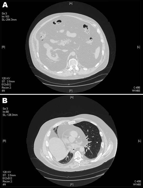 Computed tomography scans of the patient, showing marked visceral adipose tissue in the abdomen (A) and thorax (B). Diffuse intrabadominal, retroperitoneal lipomatosis, and herniation of the mediastinum can be seen through the esophageal hiatus. Intrapericardial adipose infiltration and adipose tissue bilaterally are seen within the pleura.