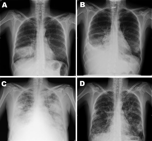 Chest radiographs of 37-year-old, HIV-positive woman with severe pandemic (H1N1) 2009 virus infection, 2009. A) June 24, alveolar infiltrate in the right lower lobe. B) July 3, minimal pleural effusion, alveolar infiltrate on right lower lobe, and possibly left lower lobe infiltrate. C) July 6, bilateral alveolo-intertitial infiltrates. D) July 29, bilateral peribroncovascular thickening with fibro-cicatricial changes; conserved lung volumes.