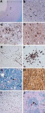 Thumbnail of Histologic findings from brain of 15-year-old boy with X-linked agammaglobulinemia and encephalitis. A) Frontal cortex with cortical thinning (double-headed arrow) and vacuolation (arrows) (Luxol fast blue stain with periodic acid–Schiff method [LFB/PAS], original magnification ×10). B) Frontal cortex with vacuolation (arrow) and rare residual neurons (arrowheads) (LFB/PAS, original magnification ×50). C) Marked astrogliosis in the frontal cortex (glial fibrillary acidic protein [GF