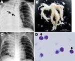 Thumbnail of A) Chest radiograph obtained at hospital admission from a child infected with influenza subtype H1N1 virus. The image shows atelectasis of the right lung and hyperinflation of the left lung; arrows indicate obstruction of the right main bronchus. B) Macroscopic bronchial casts extracted by intratracheal suction. C) Chest radiograph obtained on hospital day 2, indicating partial resolution of atelectasis of the right lower lobe. D) Light micrograph of casts, characterized by predomin