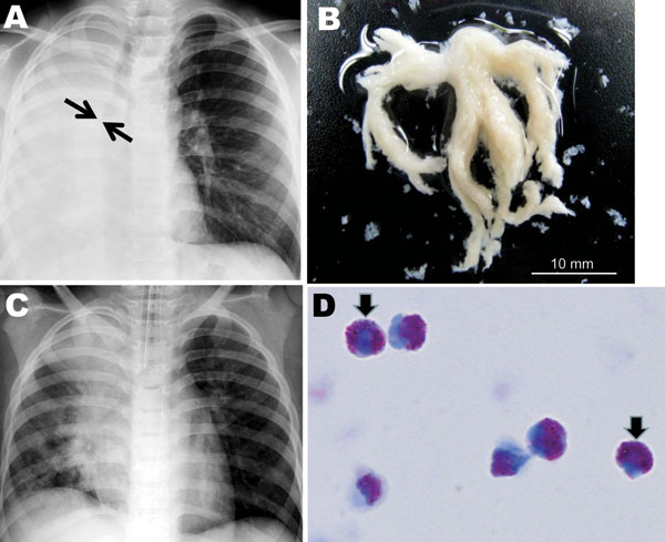 A) Chest radiograph obtained at hospital admission from a child infected with influenza subtype H1N1 virus. The image shows atelectasis of the right lung and hyperinflation of the left lung; arrows indicate obstruction of the right main bronchus. B) Macroscopic bronchial casts extracted by intratracheal suction. C) Chest radiograph obtained on hospital day 2, indicating partial resolution of atelectasis of the right lower lobe. D) Light micrograph of casts, characterized by predominant eosinophi