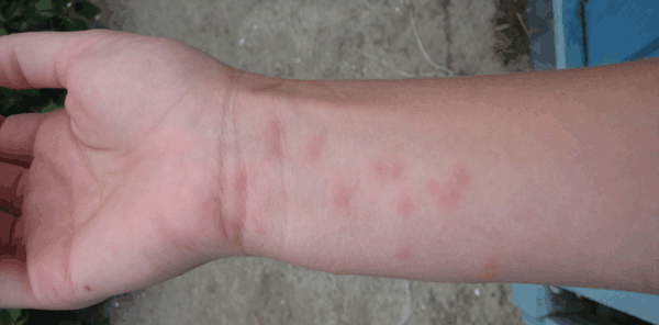 Cercarial dermatitis contracted in San Francisco Bay, California, USA, by one of the authors (S.V.B.).