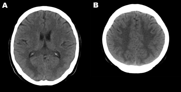 Computed tomography images of the brain of an adult patient with pandemic (H1N1) 2009 virus infection and neurologic signs. A noncontrast study showed hypodense lesions in both occipital lobes (A) and in both upper parietal lobes (B).