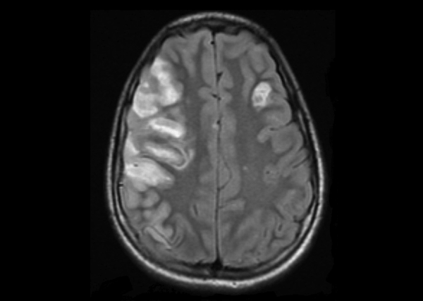 Magnetic resonance image of the head of the patient, a 13-year-old boy, showing multiple areas of infarction bilaterally with the largest in the right middle cerebral artery distribution and a smaller one in the left frontal region consistent with embolic infarcts.