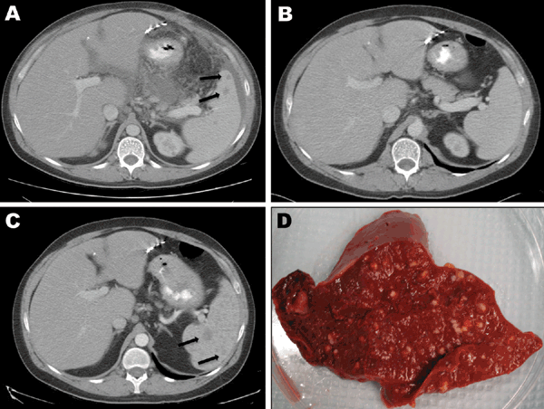 Radiologic and pathologic findings of Granulibacter bethesdensis infection in patient 2, a 36-year-old man from the United States with X-linked chronic granulomatous disease. A) Contrast-enhanced computed tomography (CT) image at initial examination (December 2005), showing multiple lucencies in the spleen (arrows) and edema and stranding in the omentum and mesentery. B) Contrast-enhanced CT image (September 2006), showing resolution of splenic lesions after prolonged antimicrobial drug therapy.