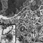 Thumbnail of Tissue sample from 30-year-old primigravida patient exposed to seasonal influenza (H1N1). Electron microscopy (original magnification ×70,000) of maternal intervillous space and fetal chorionic villi, showing intranuclear viral transcription aligning along the nuclear envelope–electron hypodensities (asterisks), and intracytoplasmic viral production in varying stages shown by numerous electron densities (V and ^). Scale bar = 500 nm. Inset: enlarged image of mature virion with capsu